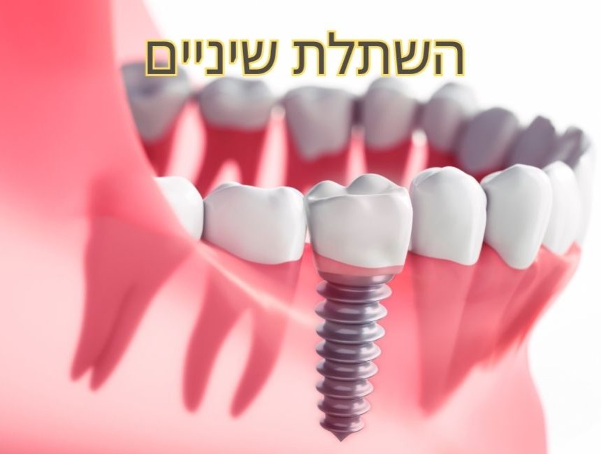 השתלת שיניים לשיקום הפה