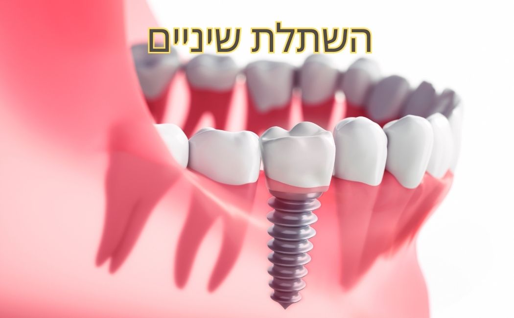 השתלת שיניים בראשון לציון