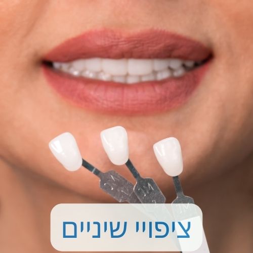 ציפויי שיניים בראשון לציון